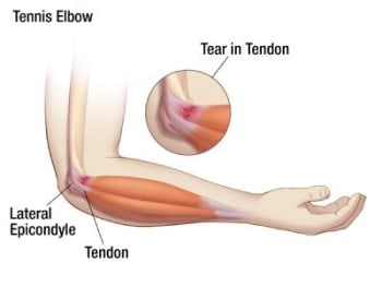 What kind of therapy do you need for tennis elbow?
