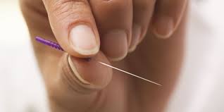 can acupuncture help with arthritis pain
