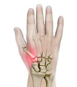 managing thumb arthritis