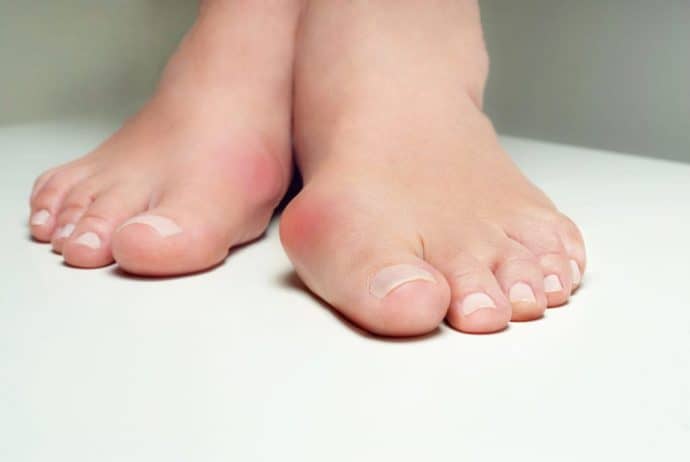 bunions - causes, symptoms and treatment