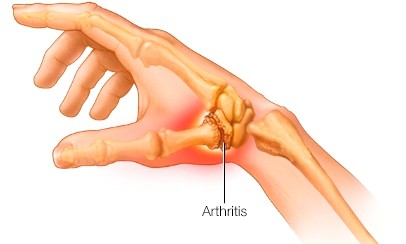 what is thumb arthritis