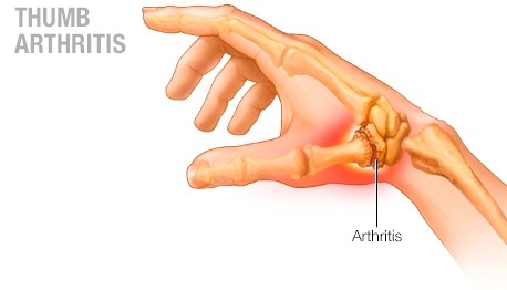 Top 10 Best Gadgets & Products for Arthritis in Hands
